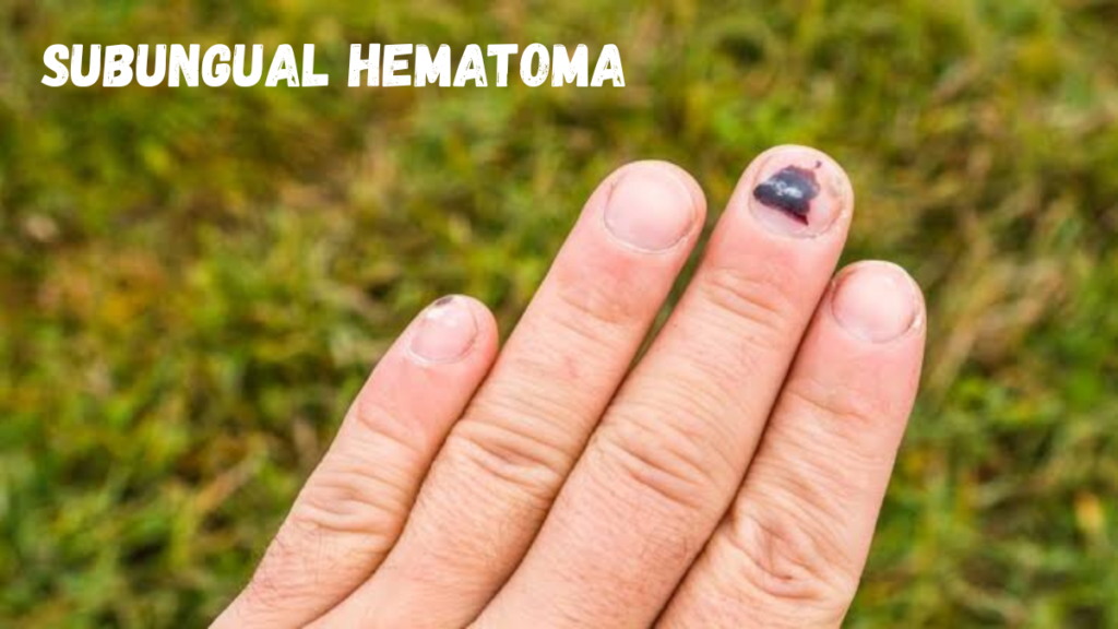 subungual hematoma